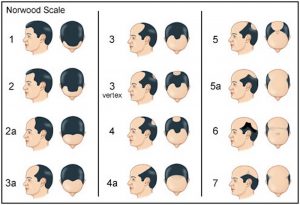 Norwood-Scale-for-hair-loss